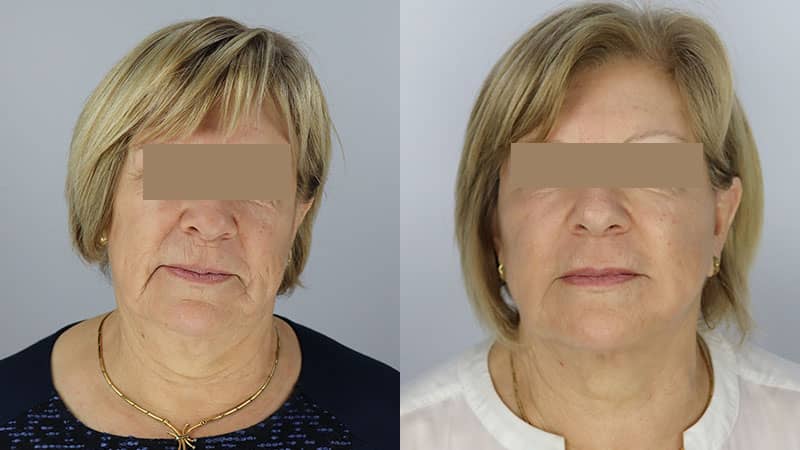 MIcro Lift Threads : Latest Revelation in Face and Body Lift