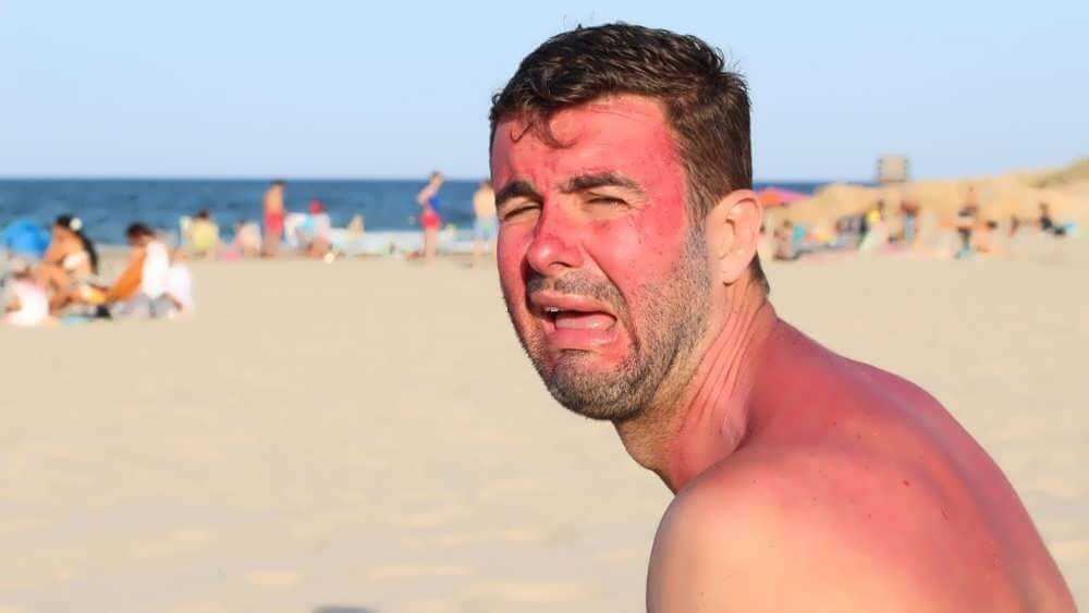 What causes sunburn