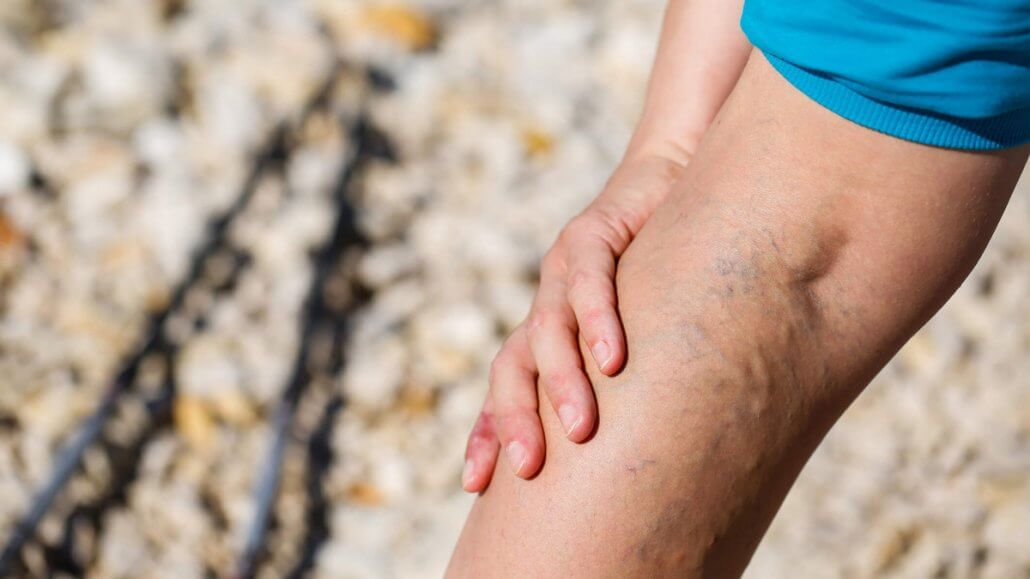 How to prevent varicose veins