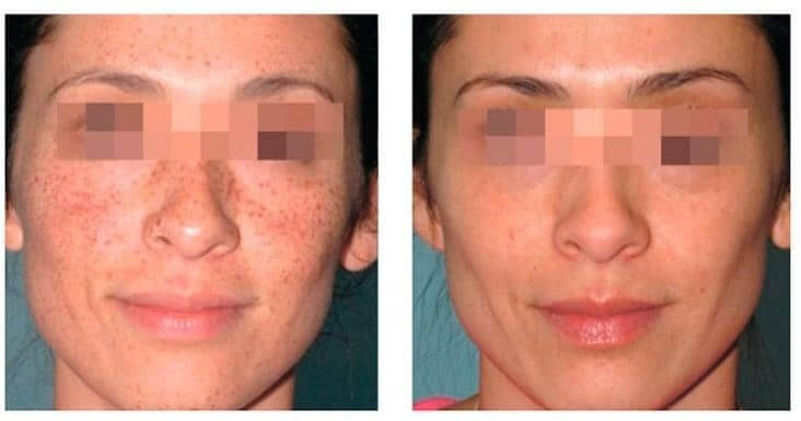 Lumecca treatment for sun damage