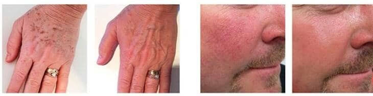 Lumecca treatment for age spots