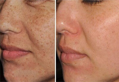 Lumecca treatment for freckles