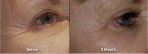 Morpheus8 Treatment for Frown lines