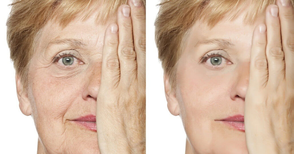 Dermal fillers are very useful for patients with early signs of aging