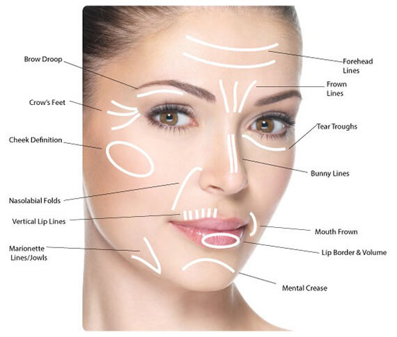 Areas Can Be Treated with Dermal Fillers