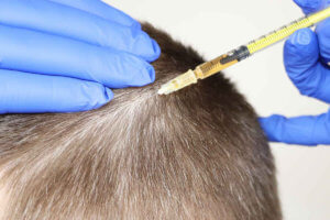 Venus-Skin-Clinic-What-Is-Mesotherapy-Hair-Loss