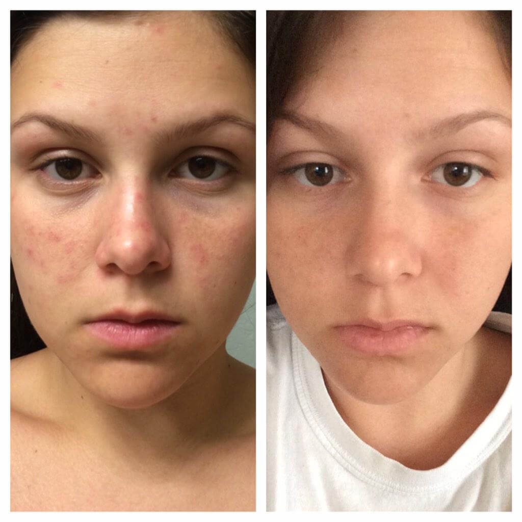 Venus-Skin-Clinic-Puracne-Oxygen-Before-After