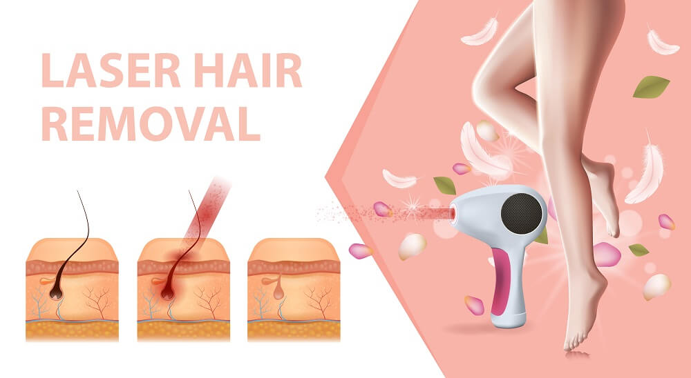 Experience the transformation with laser hair removal. See the impressive laser hair removal result.